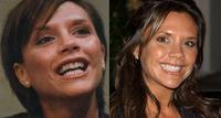 Venner technology - Celeb smiles before-after pictures