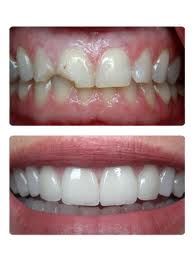 Veneer technology in Budapest | Before-after pictures