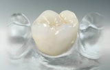 Fogpótlások - kerámia leplezésű korona | Egressy Dental 14. kerület