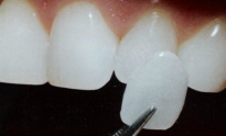Porcelán héjak készítése Zugló fogászatán | Egressy Dental 14. kerület