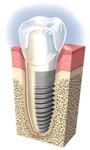 Implantálás Zugló fogászatán | Egressy Dental 14. kerület