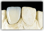Fogpótlások - fémmentes kerámia korona | Egressy Dental 14. kerület